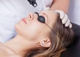 Unibrow Laser Hair Removal